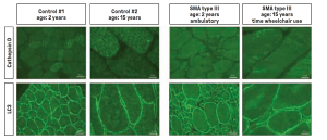 The microscope images show stained muscle biopsies from seven SMA patients aged two and 15 years who had not received any drug therapy. Result: Compared to the control samples from healthy individuals, the protein cathepsin D was downregulated as a uniform pattern in all samples. As a control, the scientists carried out another immunostaining of another protein, LC3. This showed no changes in the muscle cells of SMA patients.
