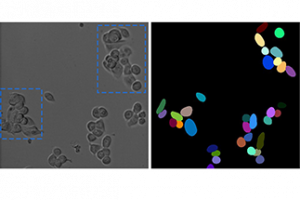 Die linke Abbildung zeigt eine Mikroskop-Aufnahme von Tumor-Zellen. Auf der rechten Seite ist die Segmentierung mittels gängiger Computerprogramme zu sehen. Sobald die Zellen dicht nebeneinander liegen oder überlappen (s. blaue Markierung) verschlechtert sich die Segmentierung. Das vollautomatische Tracking führt daher im Ergebnis zu Ungenauigkeiten.