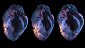 Lichtblatt-Fluoreszenzmikroskopische Aufnahme der Immunzell-Infiltration (rot-orange) in einem murinen Herzen (blau) nach Herzinfarkt.
