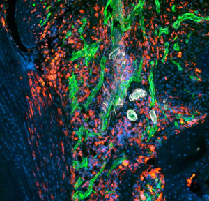 Infiltration von Immunzellen (rot) und entzündungs-getriebene Angiogenese von Blutgefäßen (grün und weiß) in einem murinen Kniegelenk während rheumatoider Arthritis.
