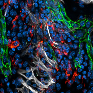 Infiltration von Immunzellen (rot) und entzündungs-getriebene Angiogenese von Blutgefäßen (grün und weiß) in einem murinen Kniegelenk während rheumatoider Arthritis.