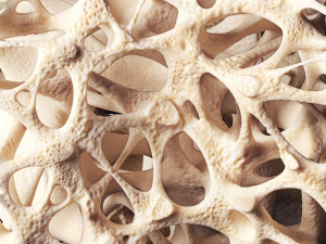 Knochenstruktur mit Osteoporose.